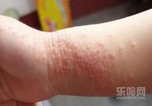 宝宝身上起红点点是怎么回事 7大常见症状 过敏性皮肤炎
