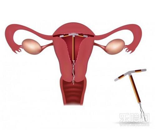 取环可以打麻药吗,取环可以打麻醉吗,取环需要