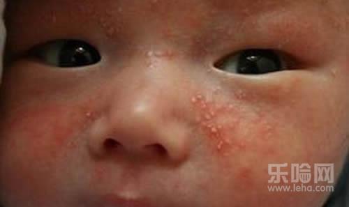 宝宝湿疹的症状,宝宝长湿疹是什么样子,宝宝长