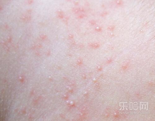 坐久了屁股上长疙瘩怎么办,屁股上长痱子怎么