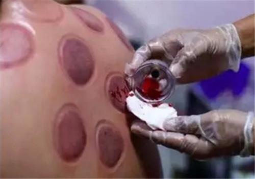 拔罐后黑紫什么原因