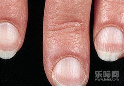 手指甲上有竖纹,指甲有竖纹是什么原因,为什么