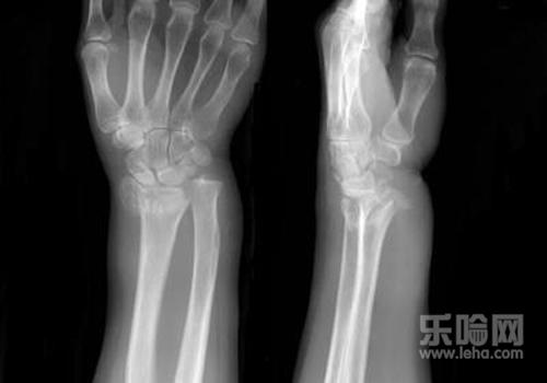 脱臼和骨折有什么区别,骨折和脱臼的区别,脱位