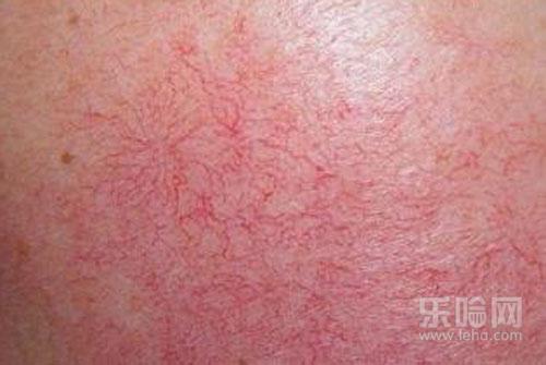 宝宝脸上有红血丝怎么回事,宝宝脸上有红血丝