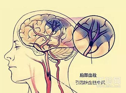 脑血栓与脑梗塞有什么区别,脑血栓和脑梗塞有