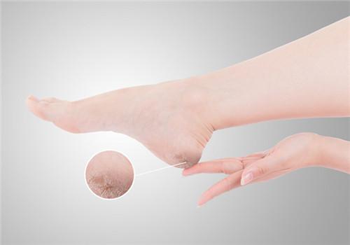 夏天脚后跟开裂什么原因