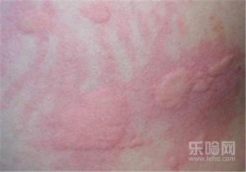 荨麻疹分为几种类型,荨麻疹有几种类型,荨麻疹