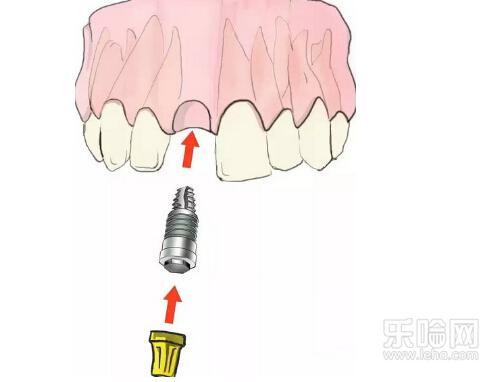 补牙后多久能吃东西,补牙几天后可以吃饭-乐哈