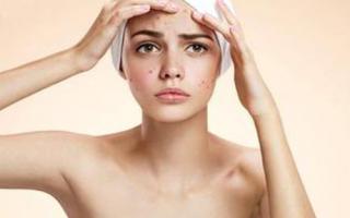 封闭性粉刺怎么才能根除,封闭性粉刺怎么去除