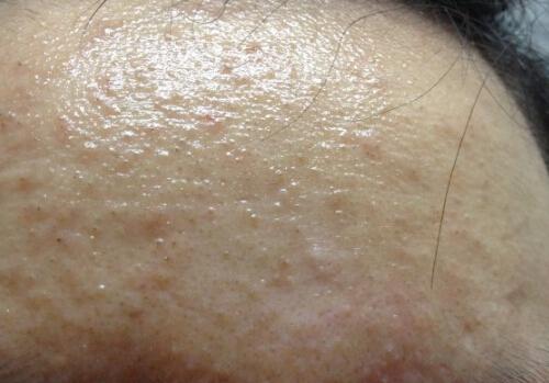 口粉刺会自己消失吗,封闭性粉刺自己会好吗-乐