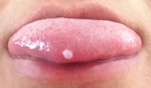 舌头起泡多久能好,舌头起泡几天能好-乐哈健康网