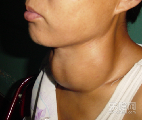 甲亢和甲状腺一样吗