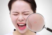女性长痘的原因是什么 长痘和内分泌有关系吗