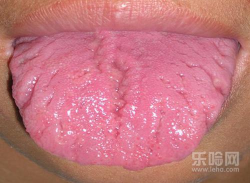 舌头中间有裂纹是怎么回事
