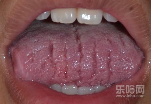 舌头中间有裂纹是怎么回事