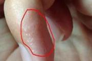 夏季皮肤痒怎么办 痒！夏天皮肤起疹、抓不停4种情况止痒大不同