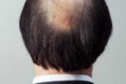 什么是脂溢性脱发