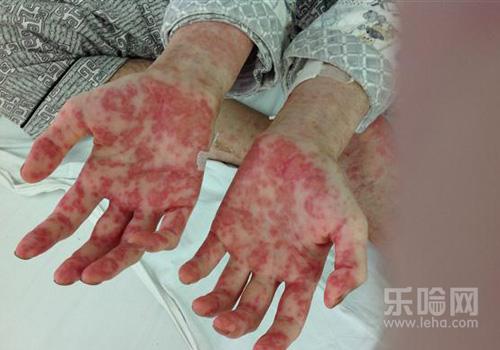 身上起了几个小红点是白血病吗?