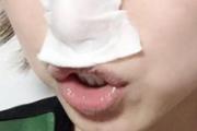 鼻贴去黑头有用吗