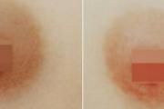 乳晕激光漂红的危害 乳晕漂红有什么缺点