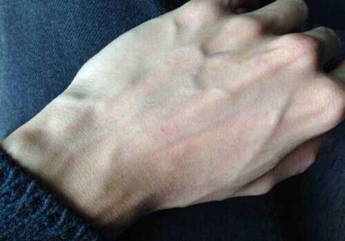 为什么有些人青筋暴露,青筋暴露是什么病