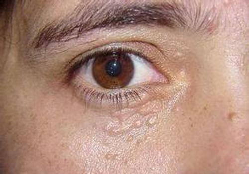 眼部扁平疣怎么去除