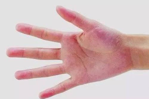 肝掌是什么样的