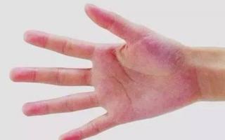 肝掌有什么症状