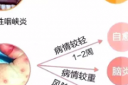 疱疹性咽峡炎和手足口病的区别