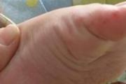 小孩手足口病能治好吗 小孩的手足口病怎么治