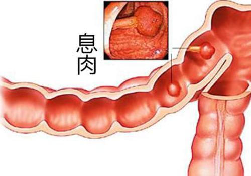 原因:息肉较大时可引致肠套叠,4肠息肉引起的便血原因:直肠炎导致腹泻