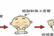 母乳性黄疸的判断标准 母乳性黄疸多少算高