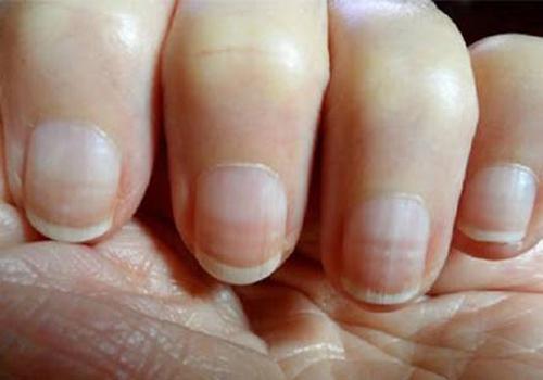 有林赛氏指甲不能吃什么 这六类食物千万不能碰