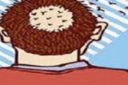 斑秃艾灸哪里 斑秃可以艾灸吗