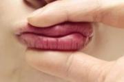 唇炎怎么治疗好的快
