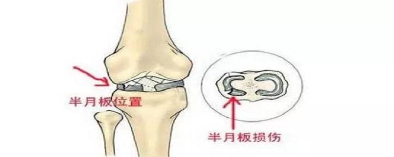 半月板切除后最多能维持几年走路 乐哈健康网 半月板切除后最多能维持几年走路 乐哈健康网