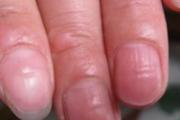 指甲分层是怎么回事