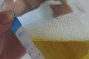 尿酸高尿液是啥颜色 尿液颜色原因分析
