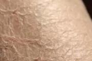 冬天腿上有皮屑怎么办 5招就能让你摆脱