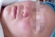 白瓷娃娃治疗过程