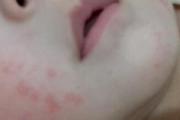 宝宝湿疹的症状