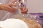 腹部拔罐可以减肥吗 腹部拔罐减肥的方法