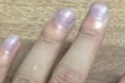 指甲发紫是怎么回事