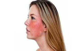 用化妆品皮肤过敏怎么办, 皮肤化妆品过敏怎么