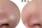 激光缩毛孔价格