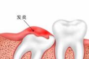 夏天能不能拔智齿 夏天拔智齿容易感染吗