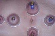 拔罐拔哪里可以减肚子 正确拔罐减肚子图