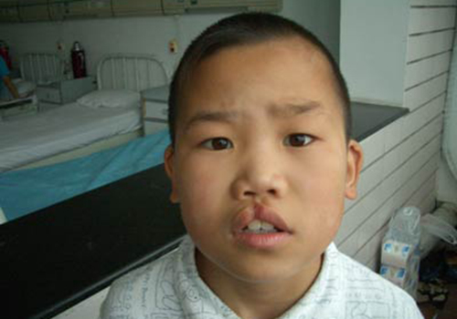 理论上来说,兔唇的孩子若是能在3婴儿兔唇会留下瘢痕吗兔唇发生的概率