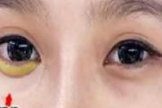 卧蚕和眼袋的区别