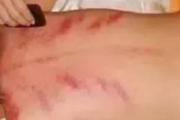 长痤疮刮痧什么部位 痤疮刮痧方法